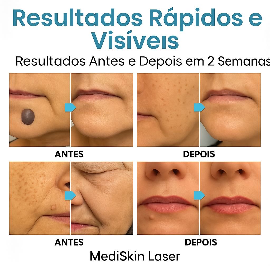 Caneta Laser MediSkin™ – Remove Manchas, Verrugas e Sinais Sem Dor - Direct Ofertas