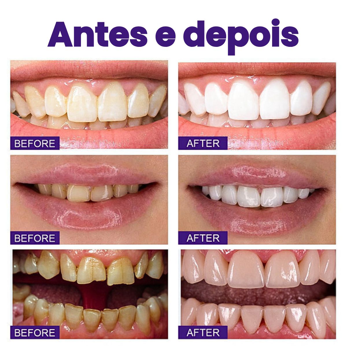 Clareador Dental iziSmile - Dentes Brancos Em Segundos [Desconto + Entrega Gratis Hoje] - Direct Ofertas