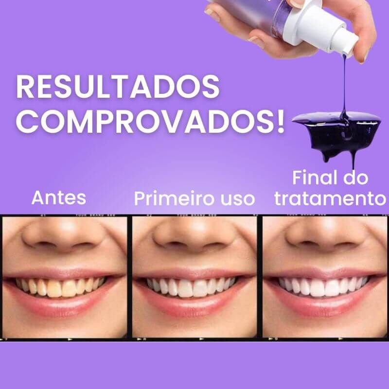Clareador Dental iziSmile - Dentes Brancos Em Segundos [Desconto + Entrega Gratis Hoje] - Direct Ofertas