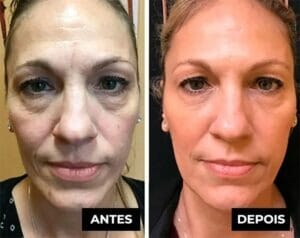 LuteinaRoll 5 em 1 ORIGINAL - Remove Olheiras, Reduz Bolsas e Revitaliza a Pele ao Redor dos Olhos - Direct Ofertas