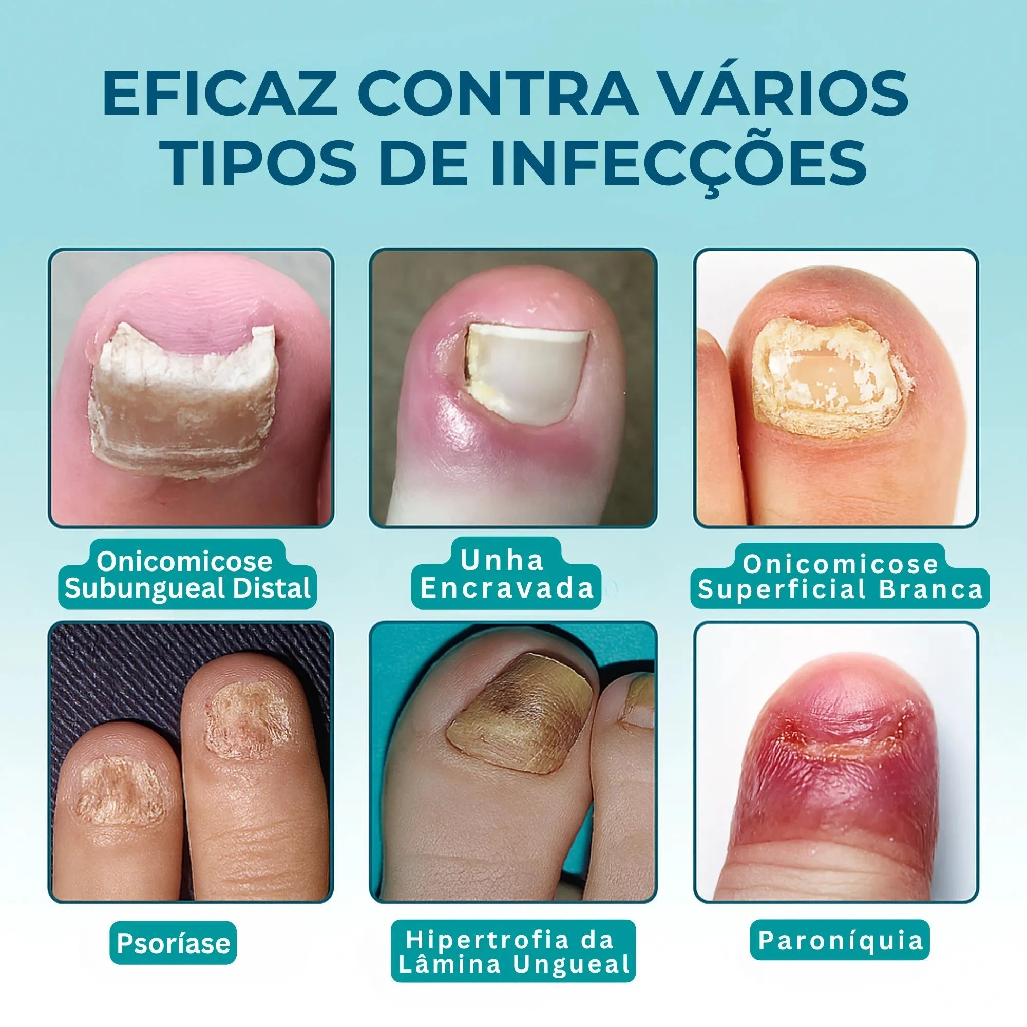 UngiGel - Adesivos para fungos UngiGel - Adesivos para fungos P11 Direct Ofertas 